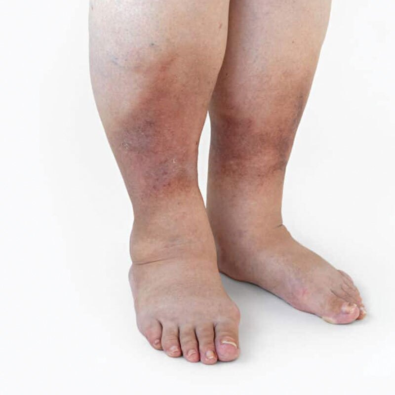legs with edema