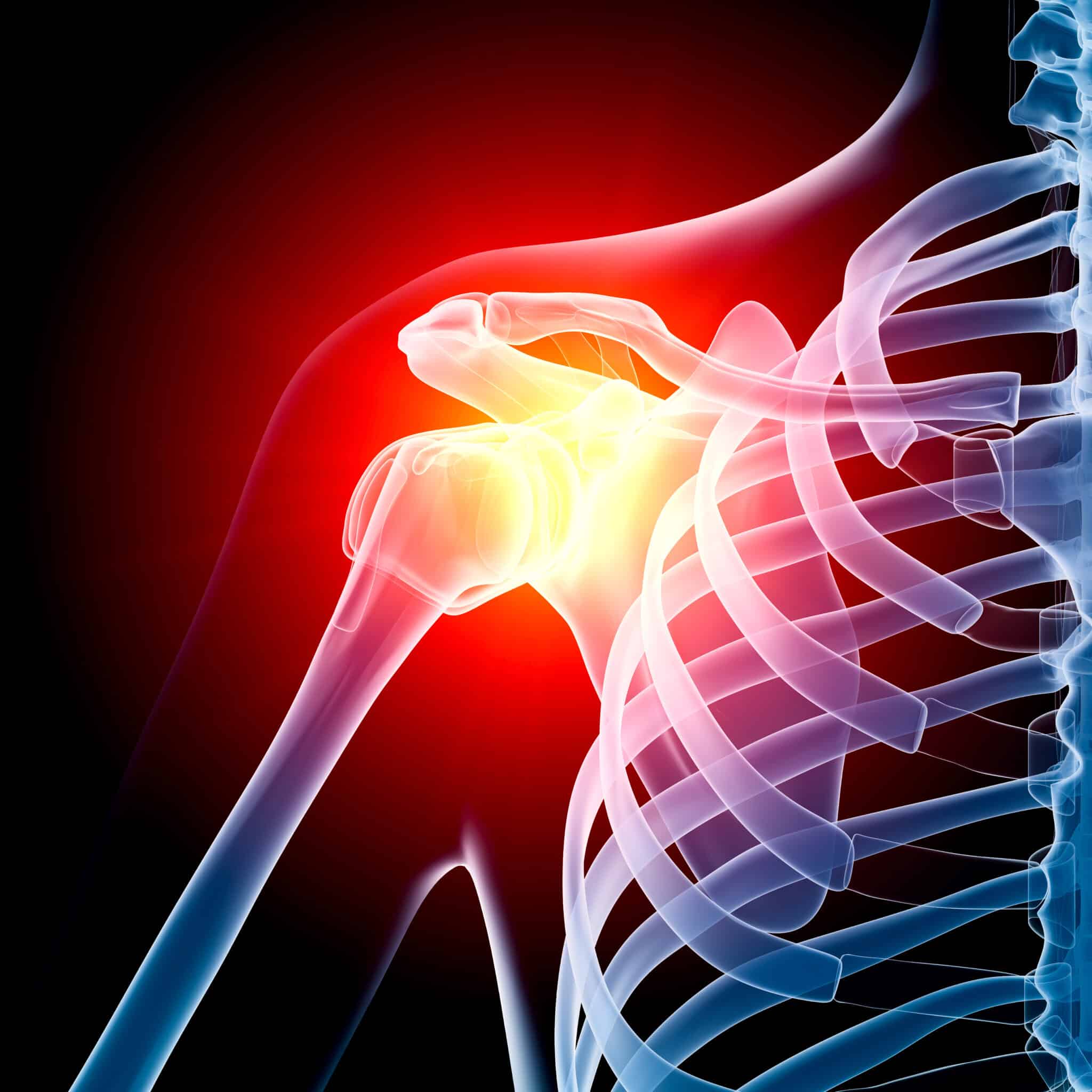 ac joint sprain diagram