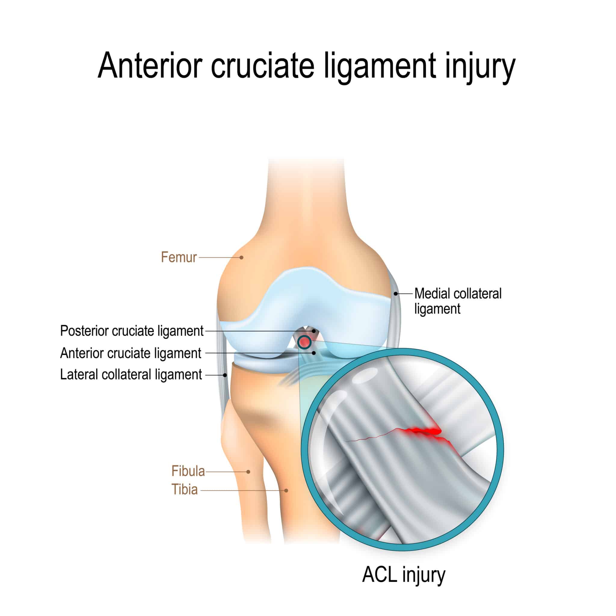 acl tear diagram