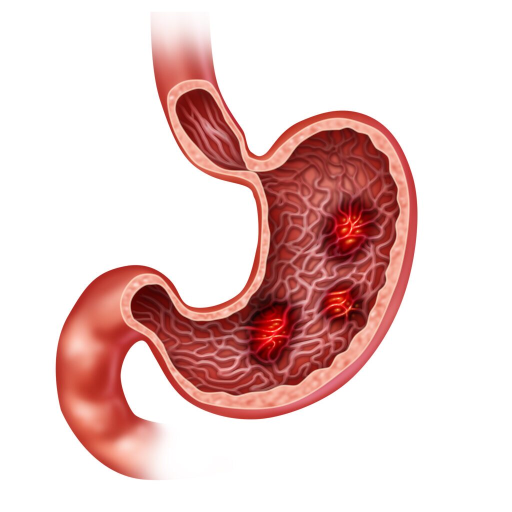 anatomical diagram of gastric ulcers