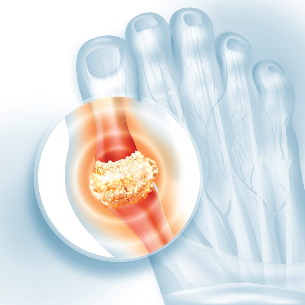 anatomical image showing gout in foot
