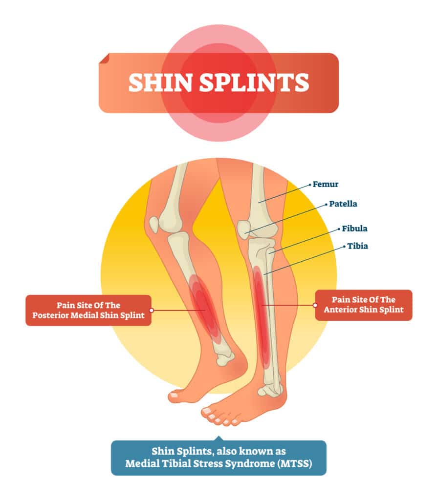 medial tibial stress syndrome diagram