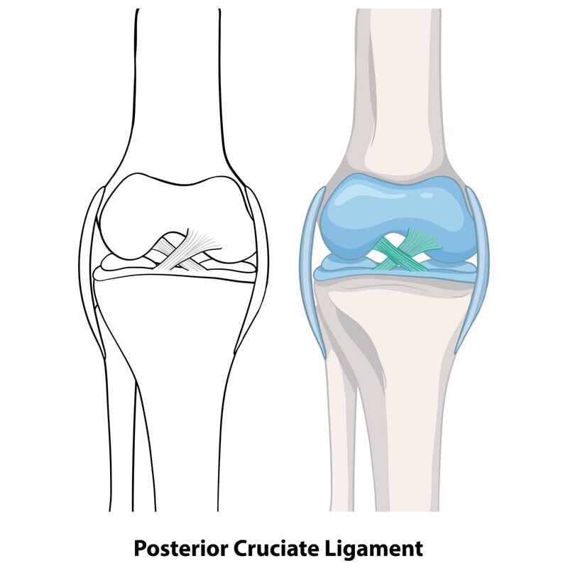 diagram of pcl tear