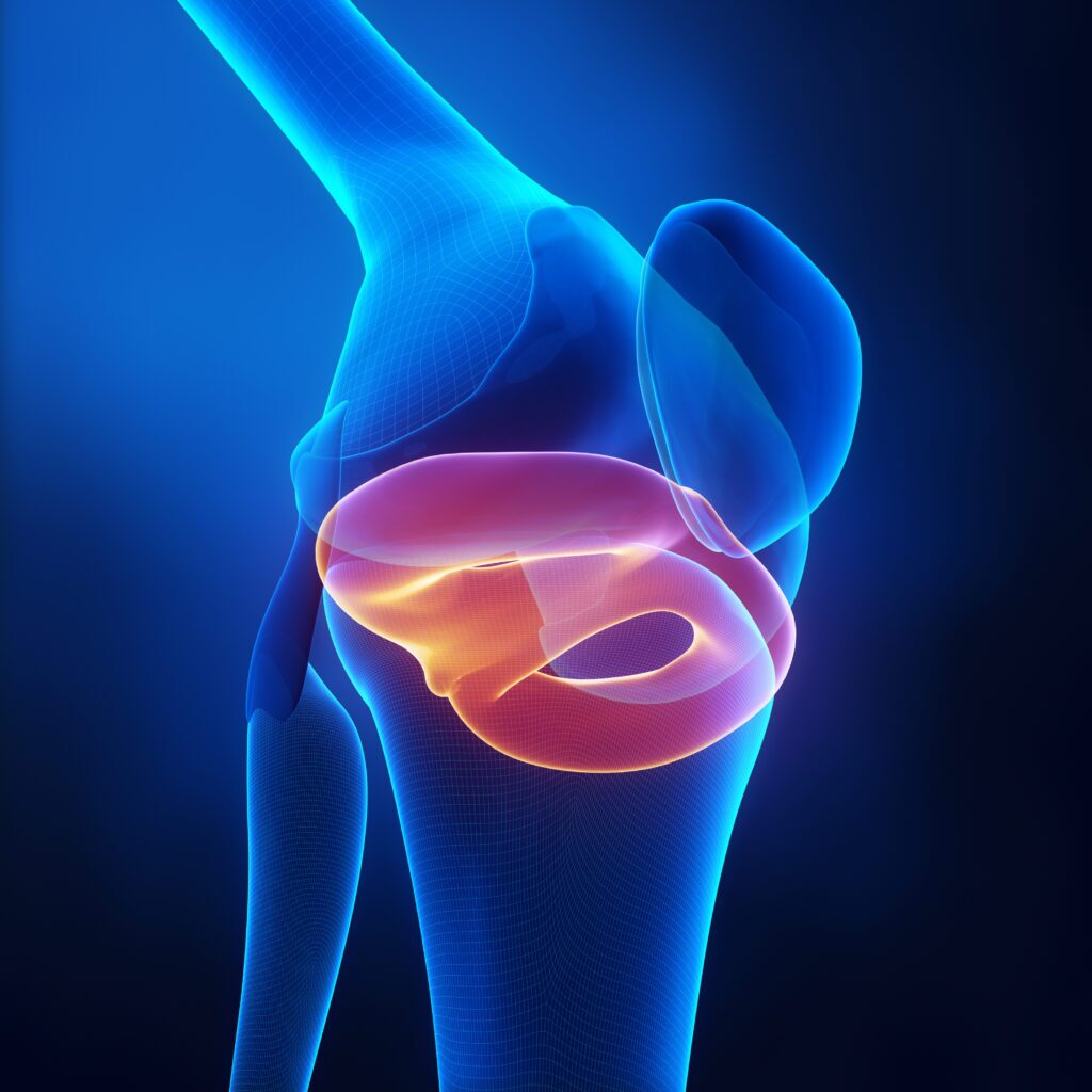 meniscal injury diagram