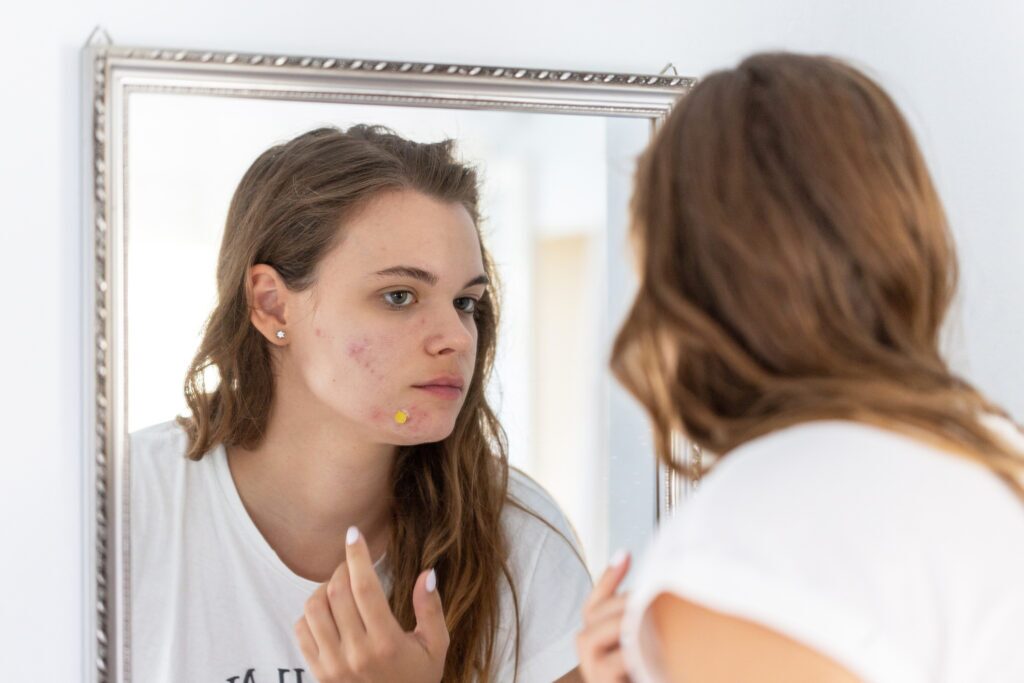 When is Acne Serious?