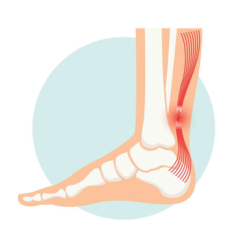 Achilles tear diagram.