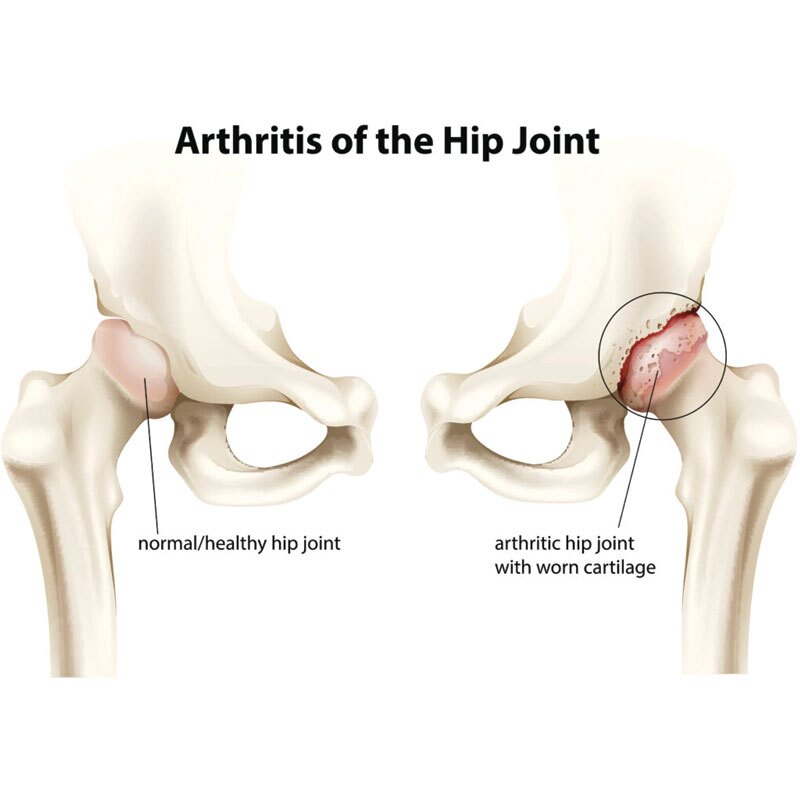 anatomical drawing of hip osteoarthritis