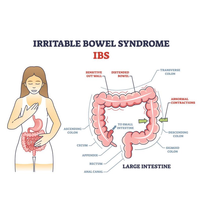 diagram of irritable bowel syndrome