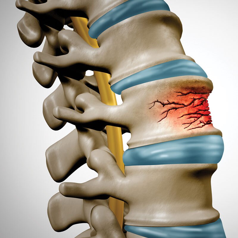 illustration of compression fractures