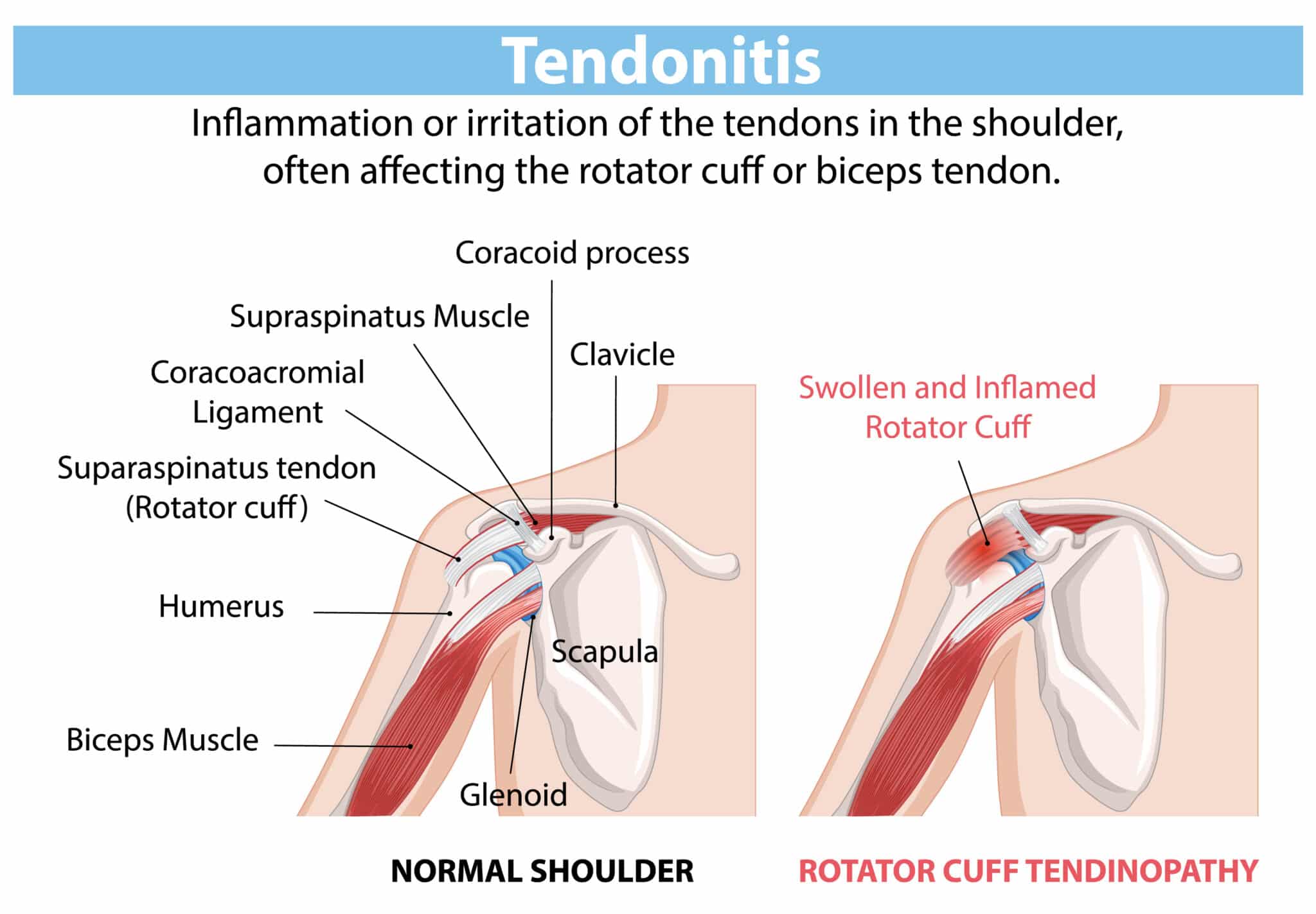 tendonitis diagram