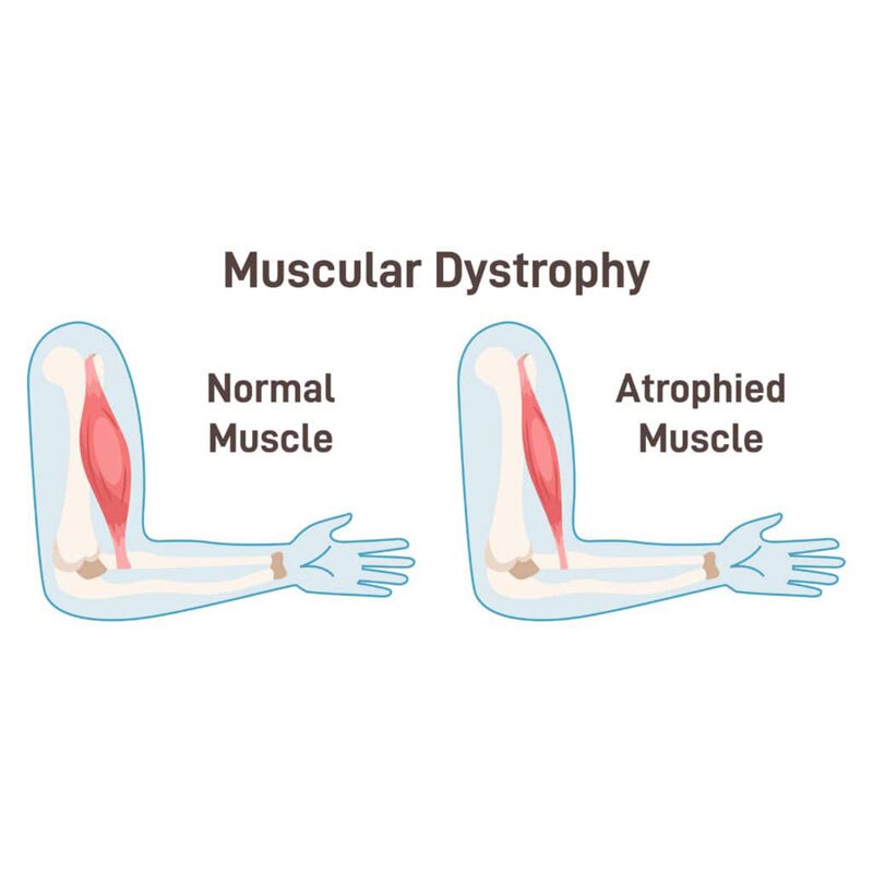 anatomical diagram of muscular dystrophy