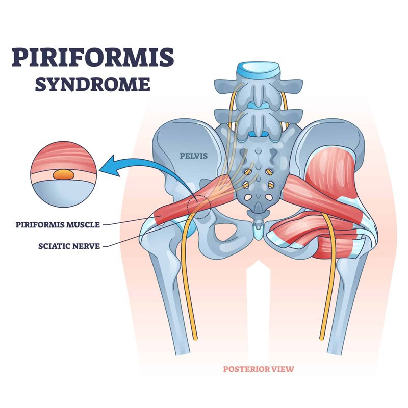 diagram of Piriformis/Deep Gluteal Syndrome