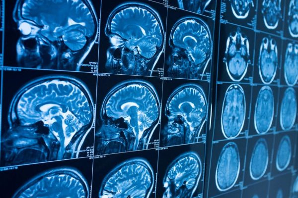 Acquired-Brain-Injuries