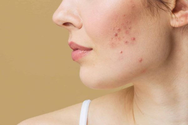 Why Acne Can Be Hard to Heal