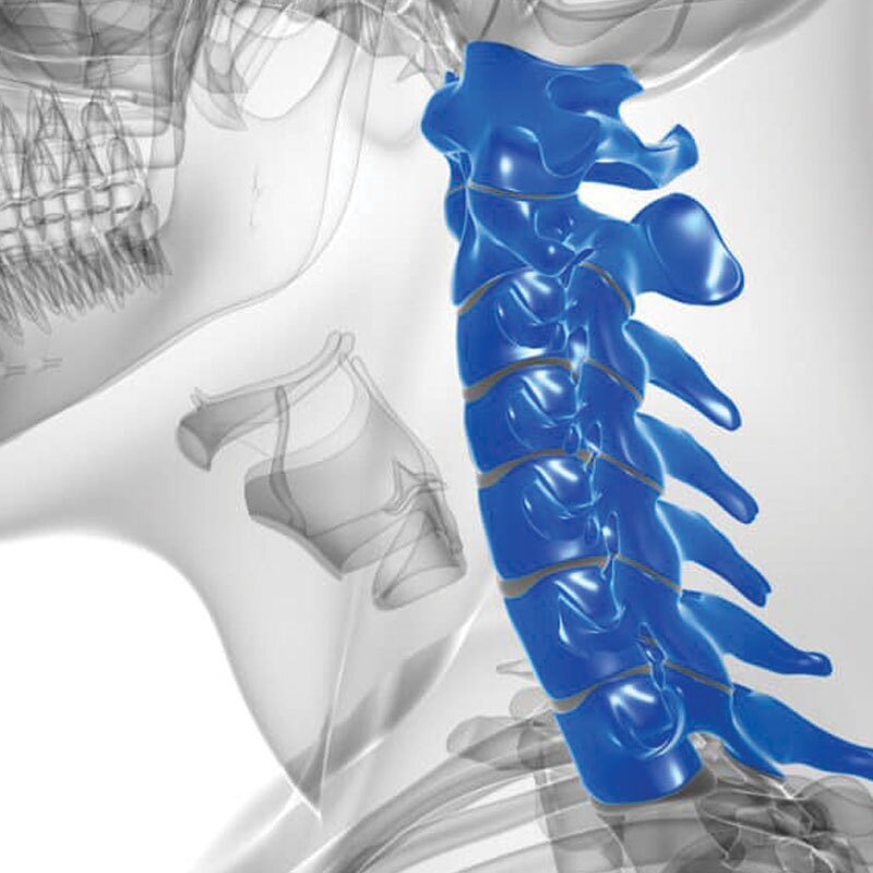 diagram of cervical stenosis