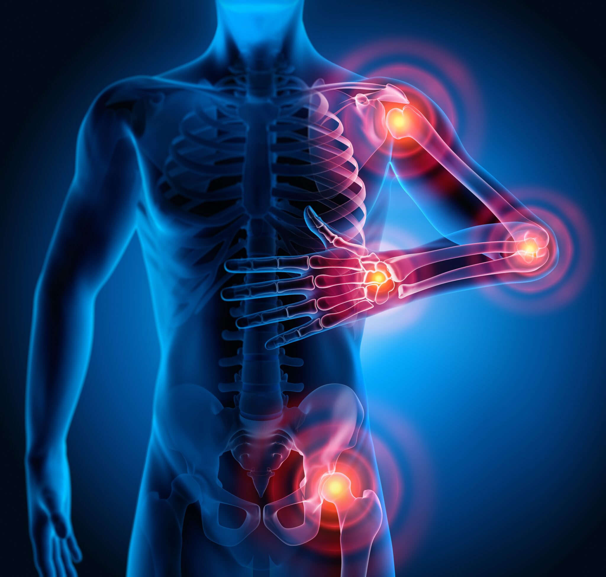 concept drawing showing rheumatoid arthritis
