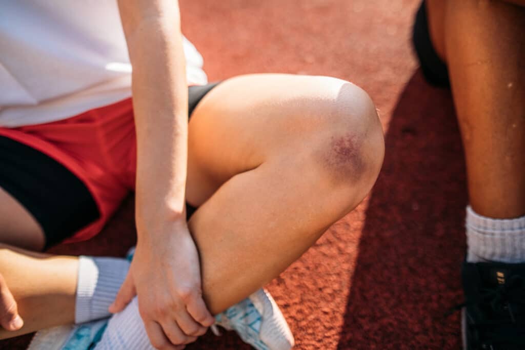 best ways to treat a contusion