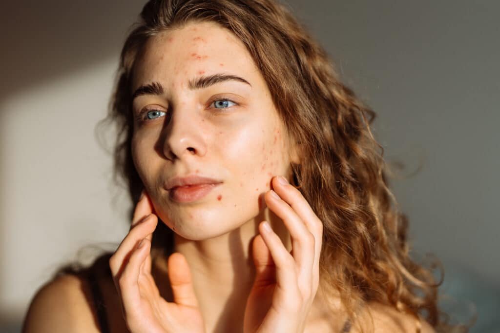 Will You Have Acne for the Rest of Your Life?