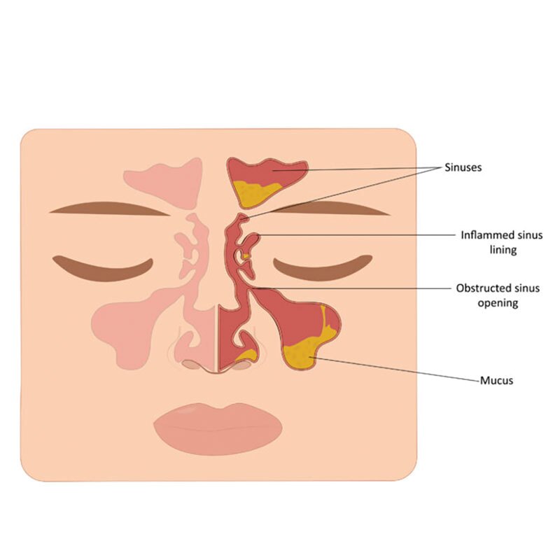 diagram of rhinosinusitis