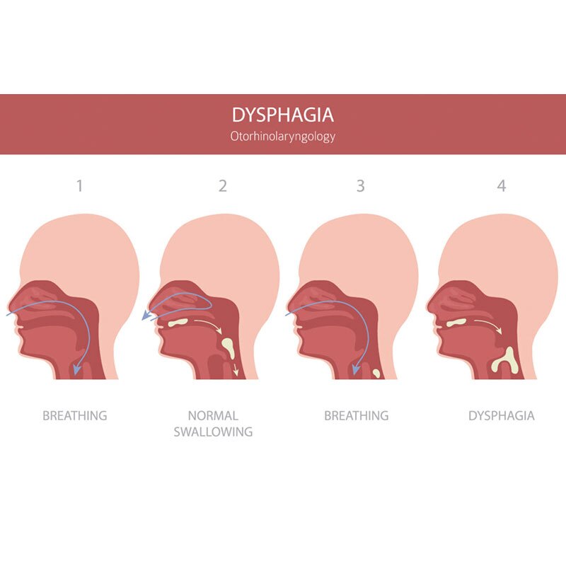 diagram of dysphagia