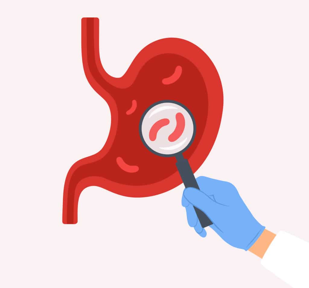 graphic showing gastritis