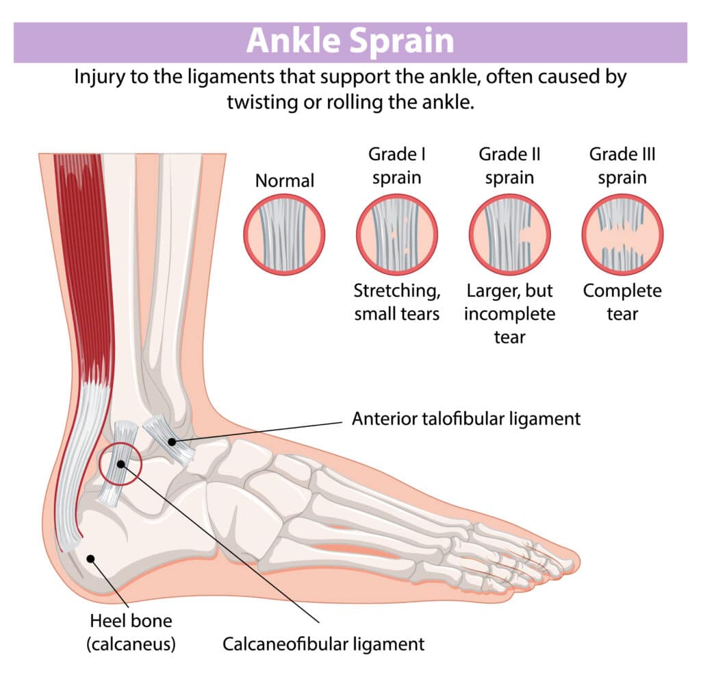 diagram of high ankle sprain
