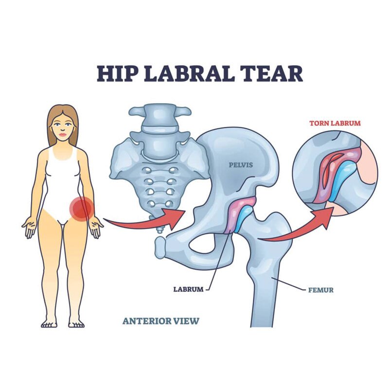 hip labral tear anatomical diagram