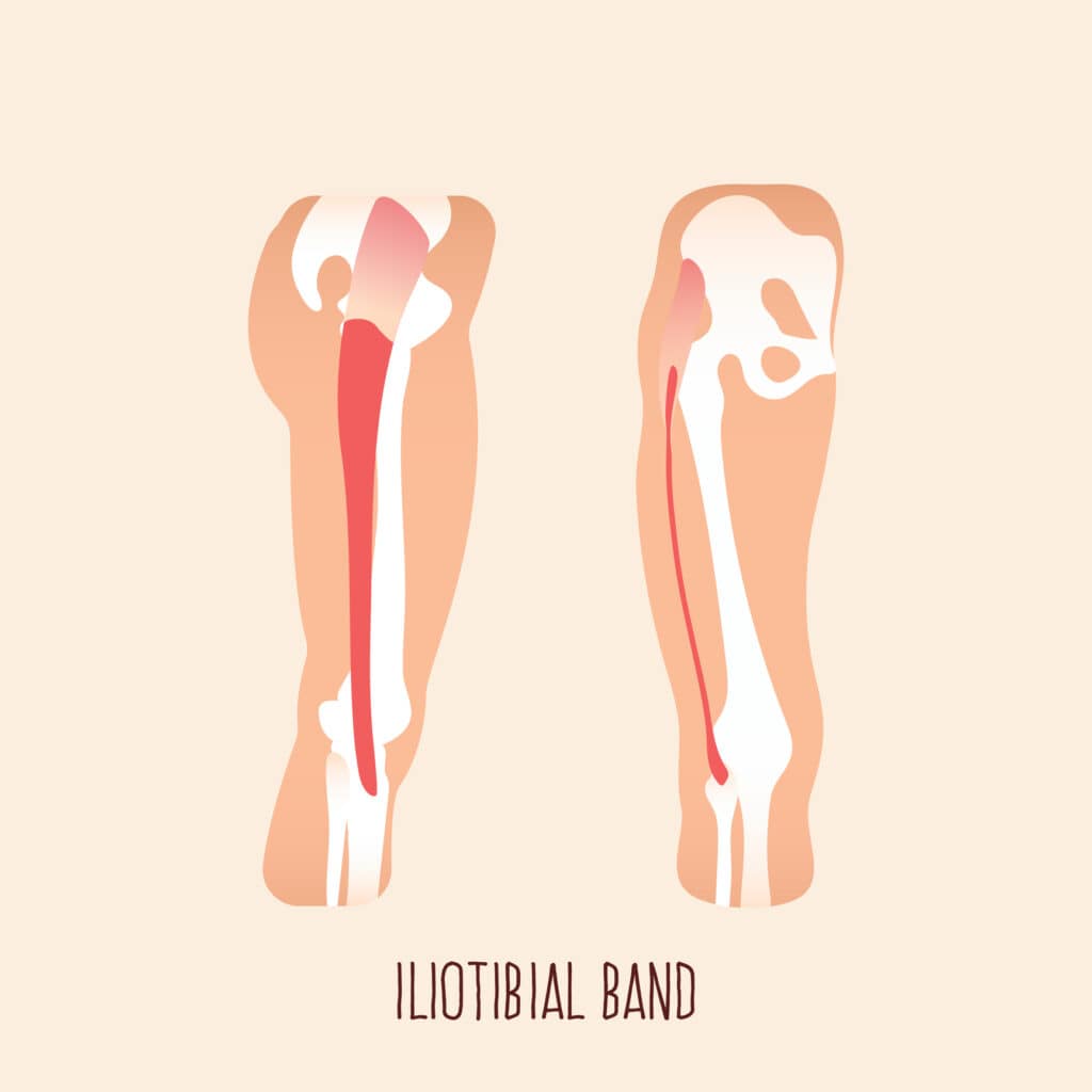 diagram of it band syndrome