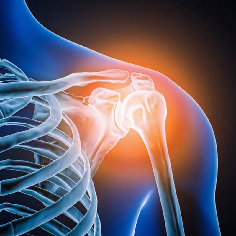 diagram of shoulder labral tear