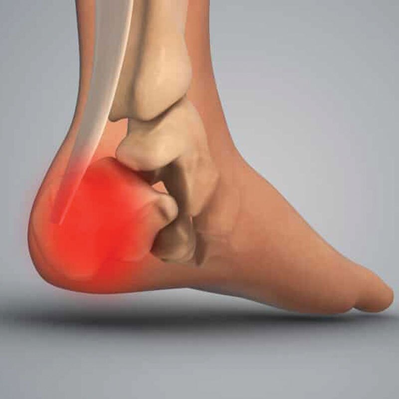 anatomy of heel fat pad syndrome pain