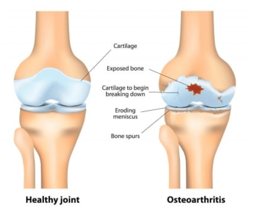 osteoarthritis - Arthritis
