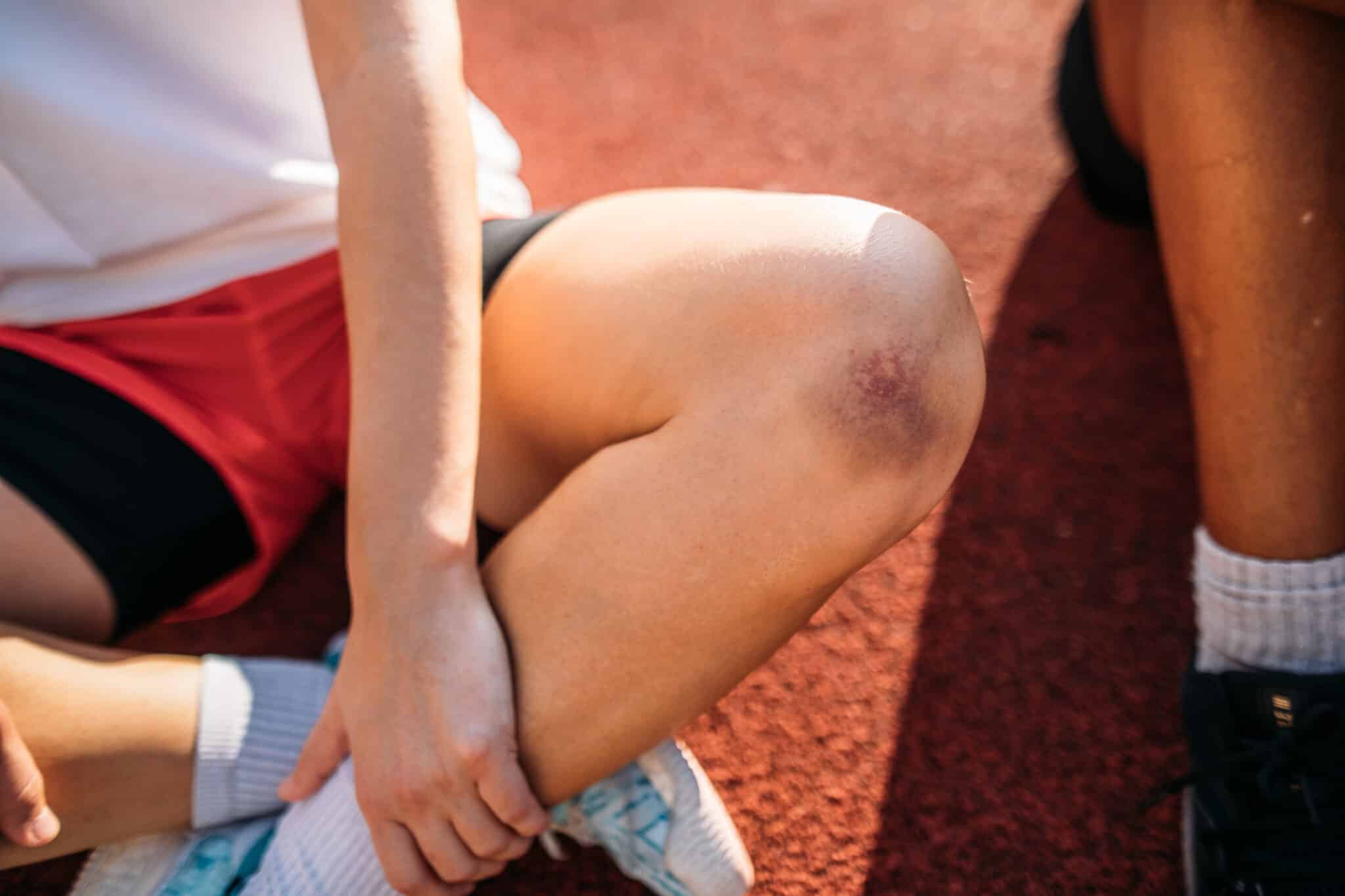 best ways to treat a contusion