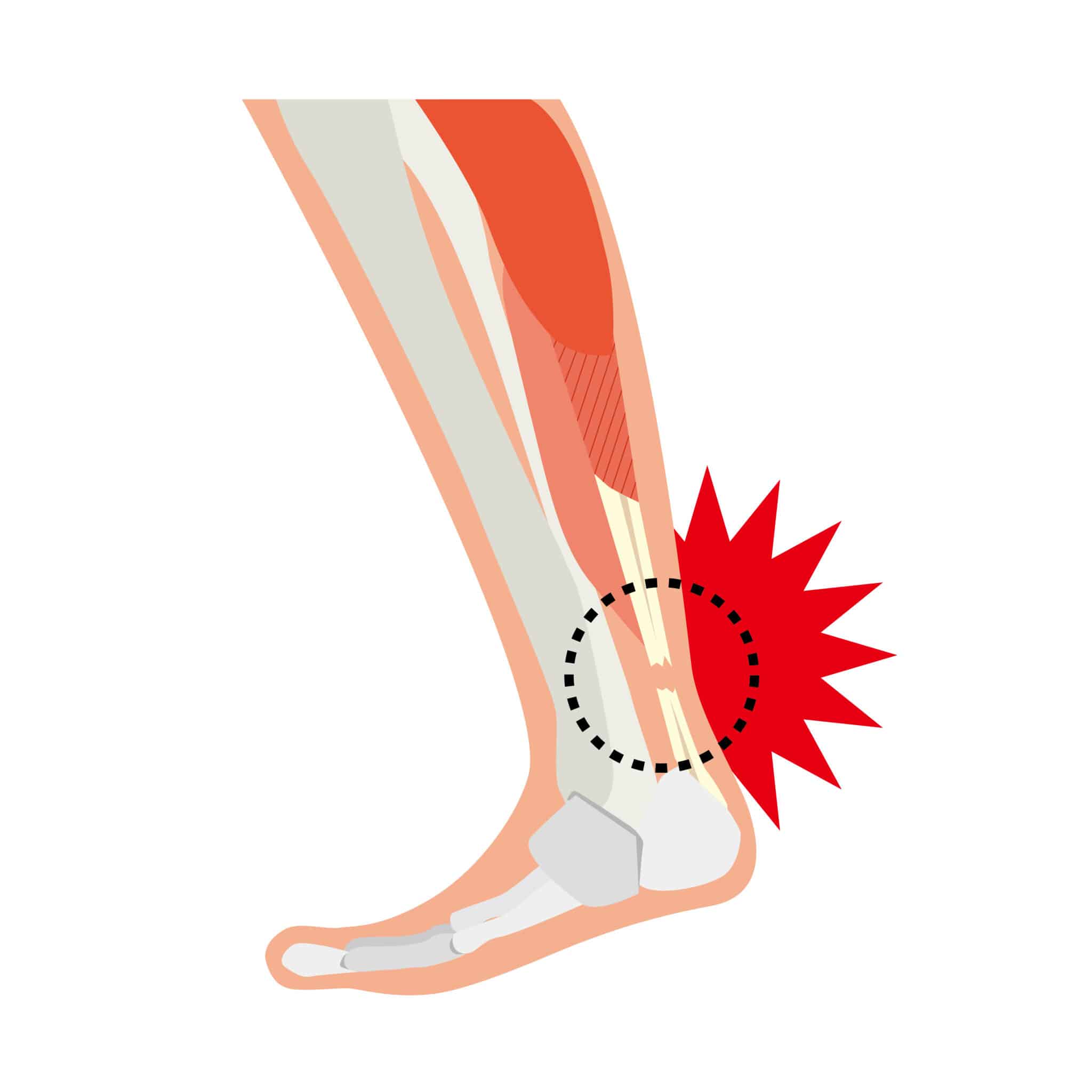 Diagram of ankle showing achilles injury.
