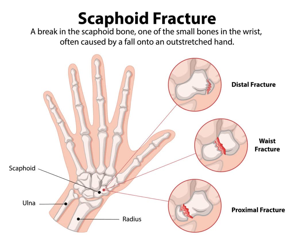 anatomical diagram of FOOSH