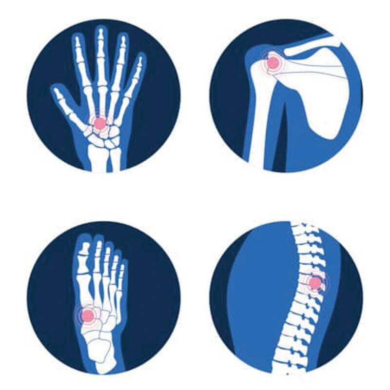 graphic depicting arthritis