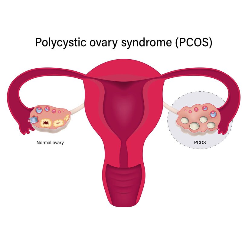 diagram of pcos