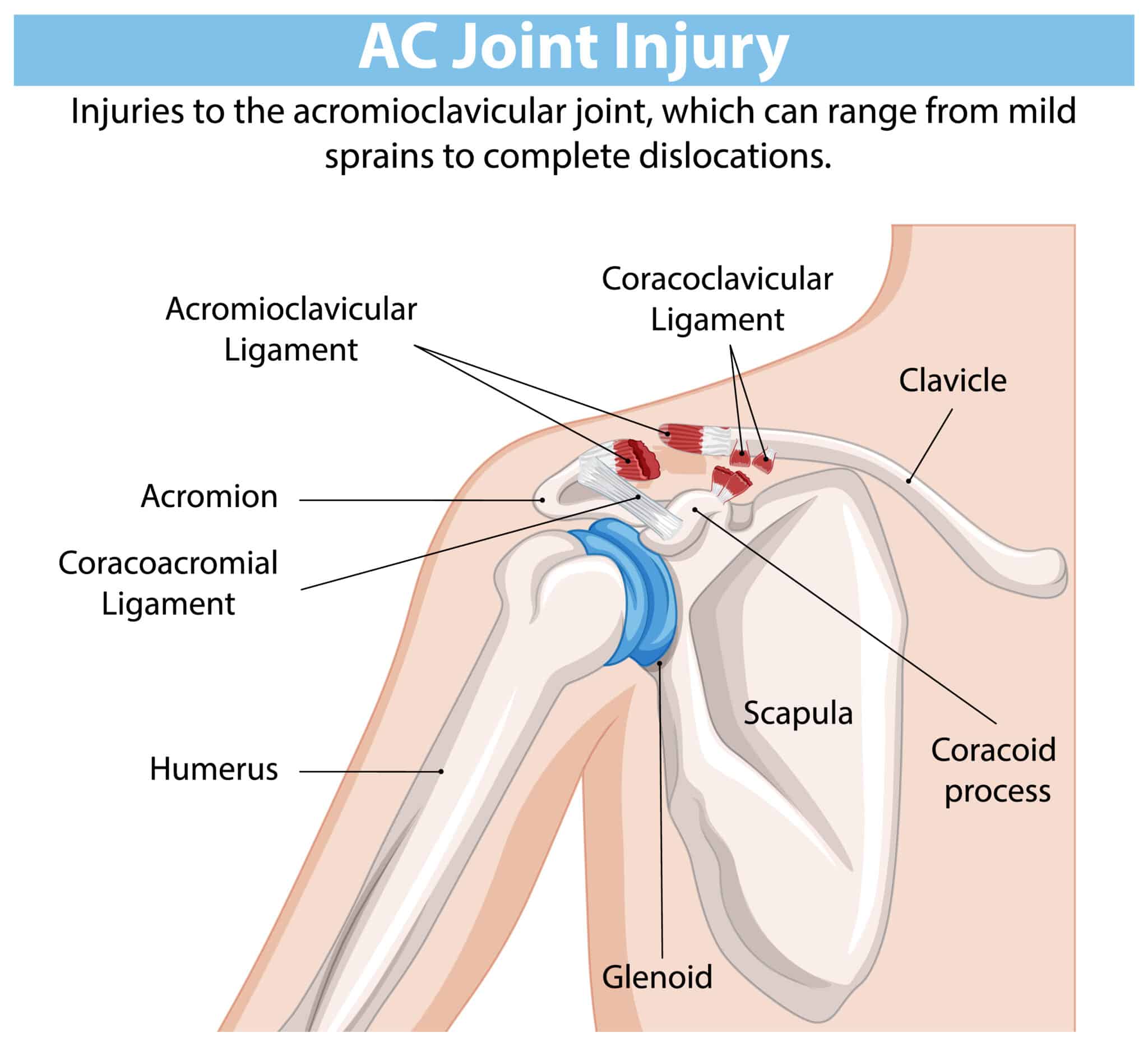ac joint strain diagram
