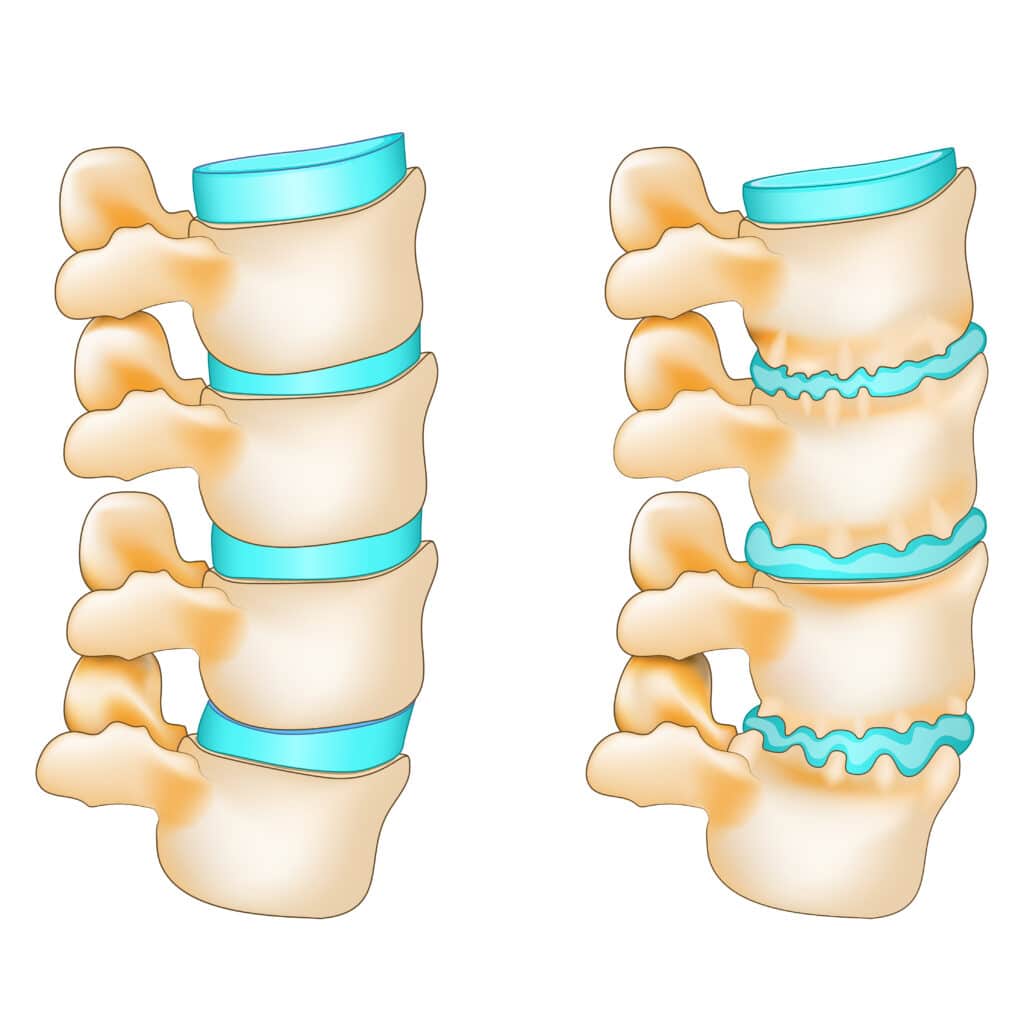 diagram of facet joint syndrome