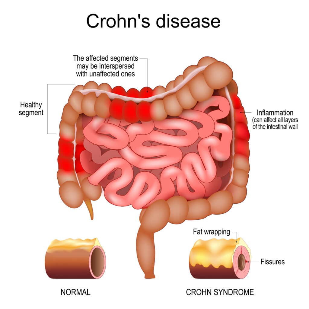 diagram of chron's disease