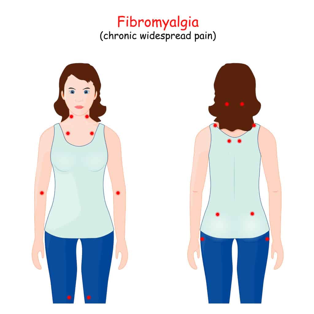 diagram of fibromyalgia pain