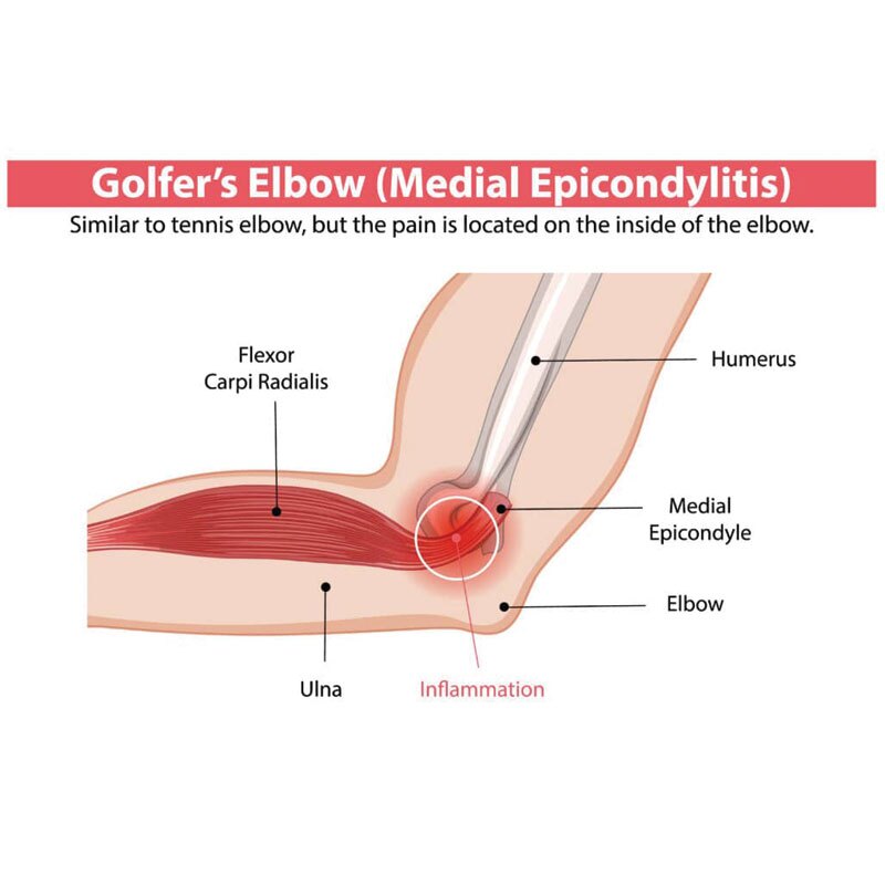 anatomical diagram of golfer's elbow