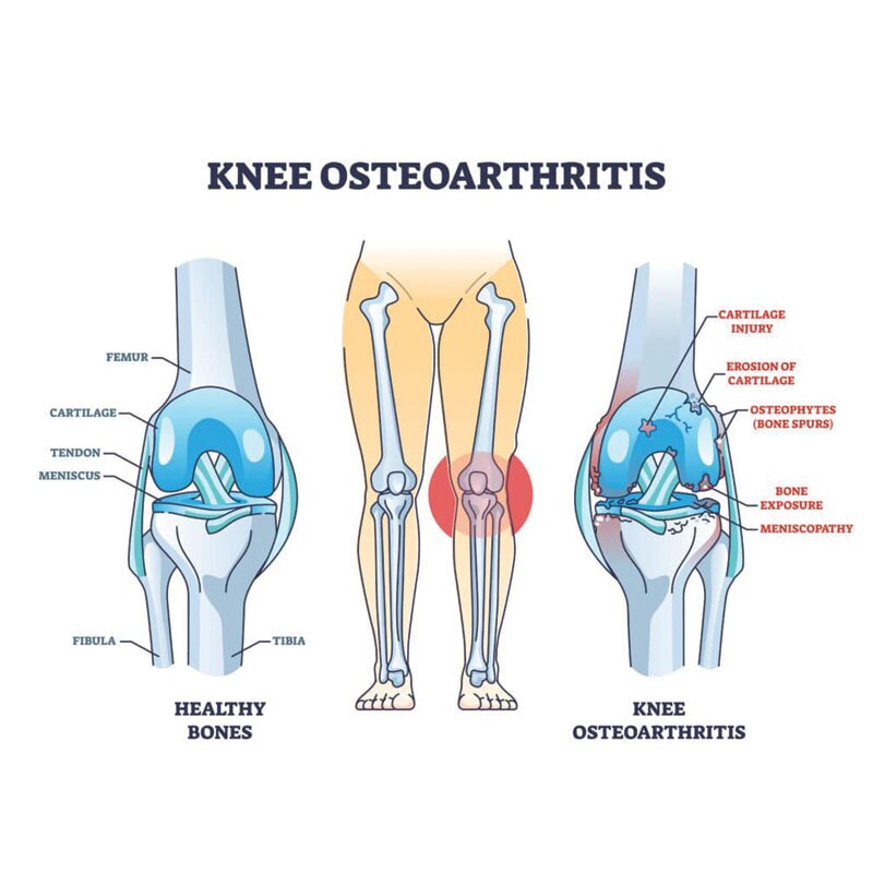 anatomical diagram of knee osteoarthritis