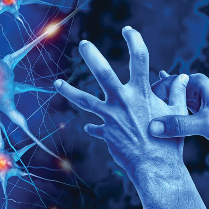 graphic depicting functional neurological disorder