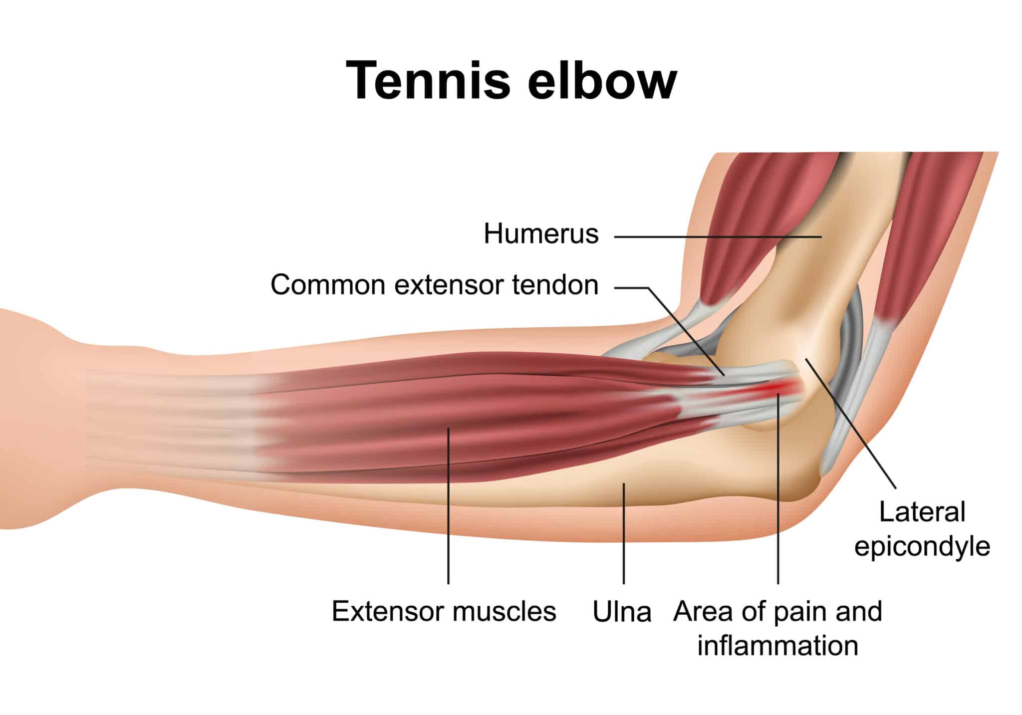 digram of tennis elbow