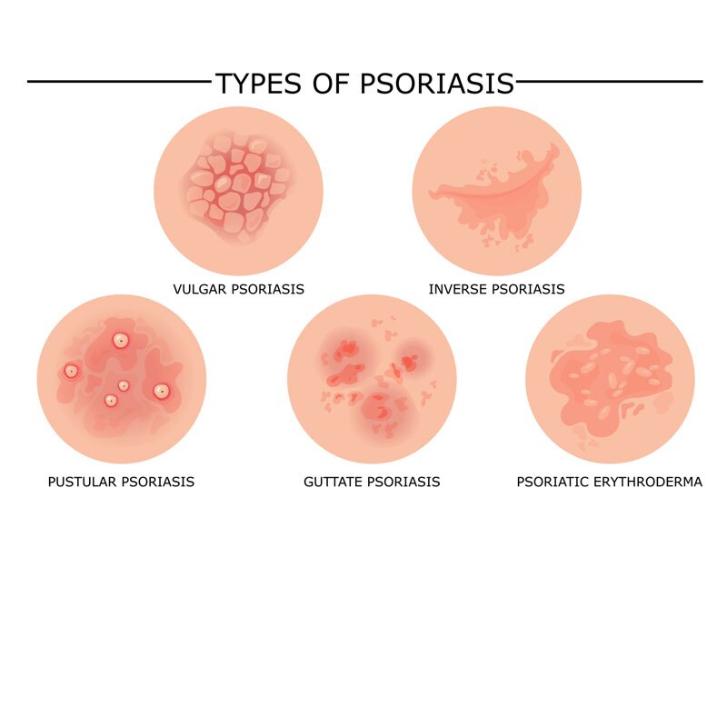 types of psoriasis