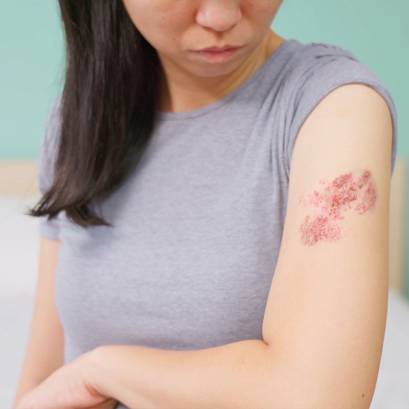 woman with shingles on her arm