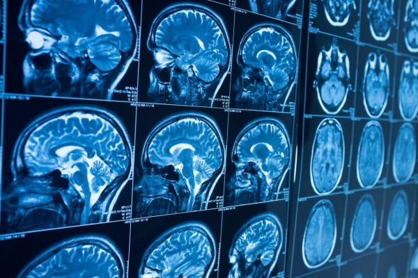 Acquired-Brain-Injuries