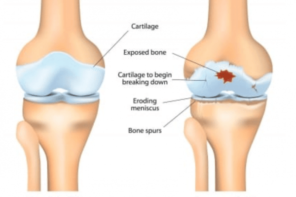 osteoarthritis