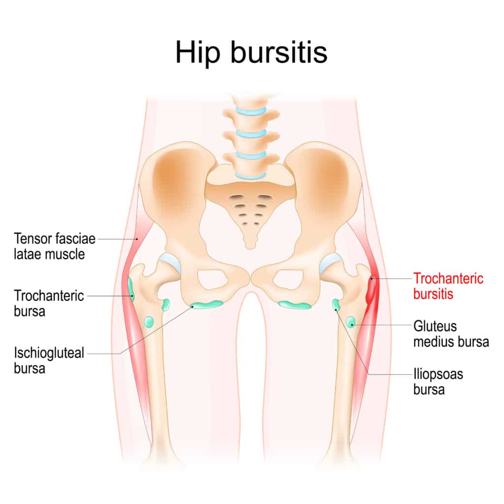 diagram of hip bursitis