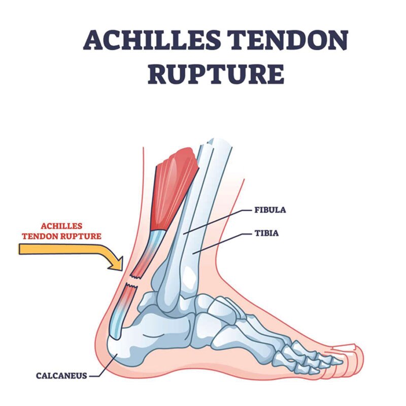 Achilles tendon rupture diagram